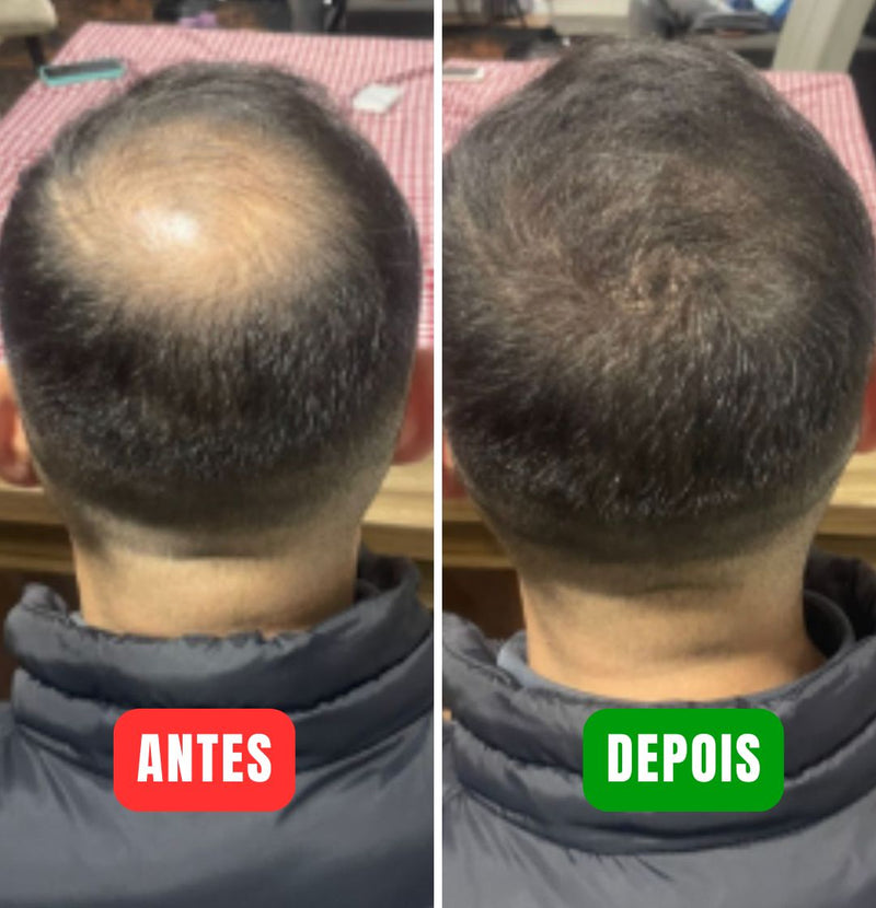 Batci Hair Concealer - Recupere sua autoestima! (Compre 1 Ganhe 3)