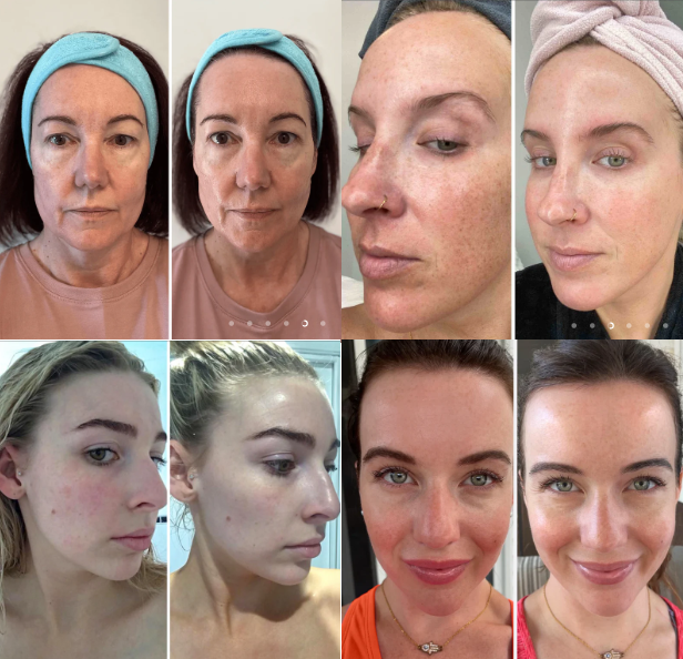 BiocollagenPlus - Máscara absorvível de colágeno + ativos do botox - Frete grátis + Brinde Exclusivo